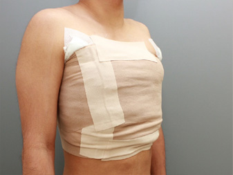 女性化乳房修正術症例№10手術直後右斜めガーゼを当てて包帯を巻いた状態
