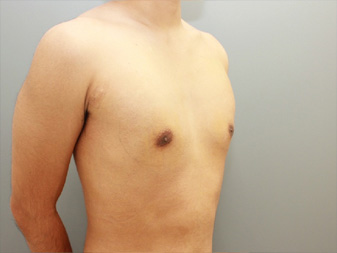 女性化乳房修正術症例№10、1週間後右斜め