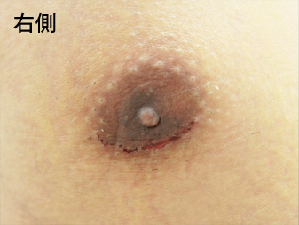 女性化乳房修正術症例№10、1週間後乳輪乳頭の状態右側