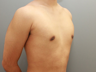 女性化乳房修正術症例№10、1か月後右斜め