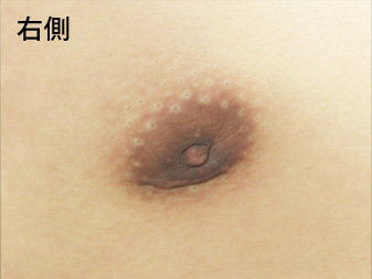 女性化乳房修正術症例№10、1ヶ月後乳輪乳頭の状態右側