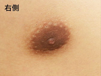 女性化乳房修正術症例№10、4ヶ月後乳輪乳頭の状態右側
