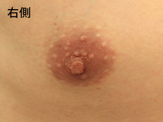 女性化乳房修正術症例№13術前右側乳輪乳頭の状態
