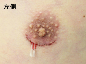 女性化乳房修正術症例№13手術直後左側ドレーン挿入の状態