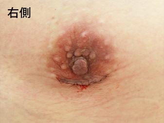 女性化乳房修正術症例№13手術翌日乳輪乳頭の状態右側