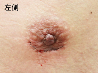 女性化乳房修正術症例№13手術翌日乳輪乳頭の状態左側