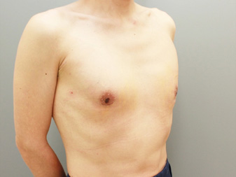 女性化乳房修正術症例№13、1週間後右斜め