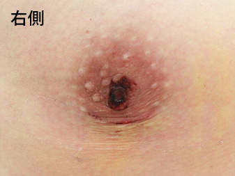 女性化乳房修正術症例№13、1週間後乳輪乳頭の状態右側