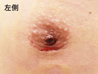 女性化乳房修正術症例№13、1週間後乳輪乳頭の状態左側