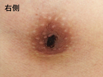 女性化乳房修正術症例№13、2週間後乳輪乳頭の状態右側