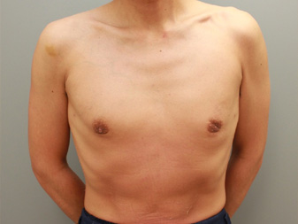女性化乳房修正術症例№13、1か月後正面