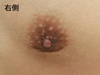 女性化乳房修正術症例№13、1ヶ月後乳輪乳頭の状態右側