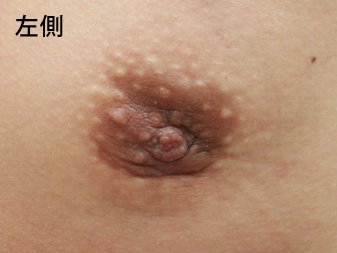 女性化乳房修正術症例№13、1ヶ月後乳輪乳頭の状態左側