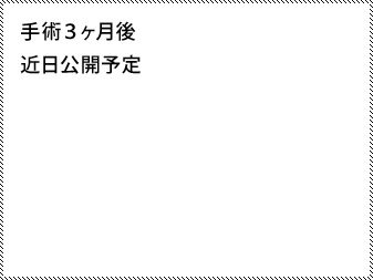 女性化乳房修正術症例№13、3か月後正面