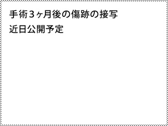 女性化乳房修正術症例№13、3ヶ月後乳輪乳頭の状態右側