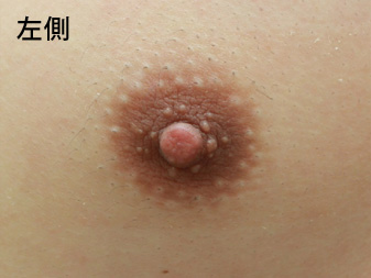 女性化乳房修正術症例№14術前左側乳輪乳頭の状態