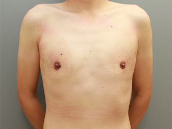 女性化乳房修正術症例№14手術翌日正面