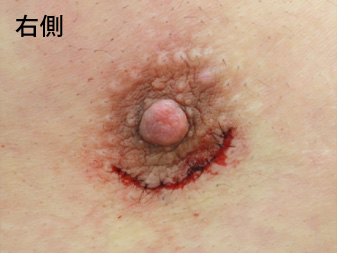 女性化乳房修正術症例№14手術翌日乳輪乳頭の状態右側