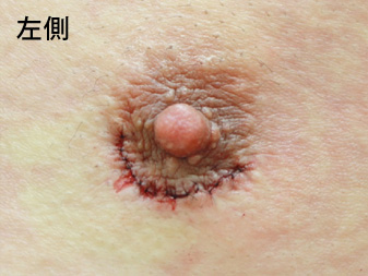 女性化乳房修正術症例№14手術翌日乳輪乳頭の状態左側