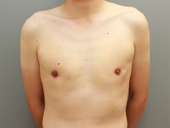 女性化乳房修正術症例№14、1週間後正面