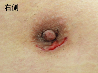 女性化乳房修正術症例№14、1週間後乳輪乳頭の状態右側
