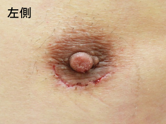 女性化乳房修正術症例№14、1週間後乳輪乳頭の状態左側