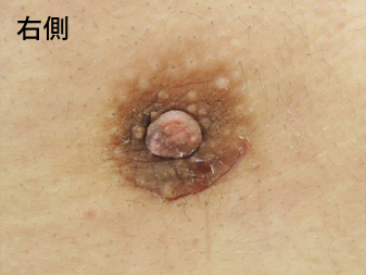 女性化乳房修正術症例№14、1ヶ月後乳輪乳頭の状態右側