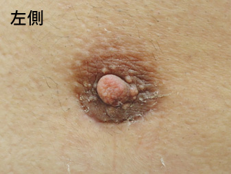女性化乳房修正術症例№14、1ヶ月後乳輪乳頭の状態左側