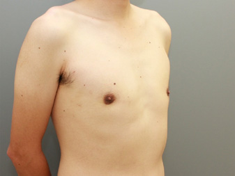 女性化乳房修正術症例№14、2か月後右斜め