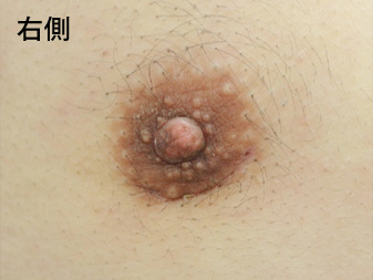 女性化乳房修正術症例№14、2ヶ月後乳輪乳頭の状態右側