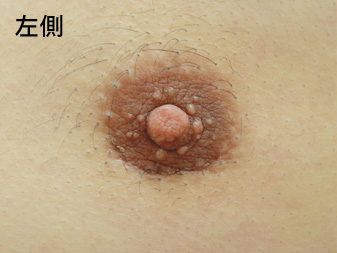 女性化乳房修正術症例№14、2ヶ月後乳輪乳頭の状態左側