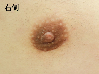 女性化乳房修正術症例№14、3ヶ月後乳輪乳頭の状態右側