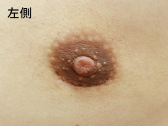 女性化乳房修正術症例№14、3ヶ月後乳輪乳頭の状態左側
