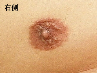 女性化乳房修正術症例№15術前右側乳輪乳頭の状態