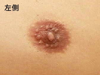 女性化乳房修正術症例№15術前左側乳輪乳頭の状態