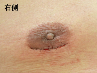 女性化乳房修正術症例№15手術翌日乳輪乳頭の状態右側