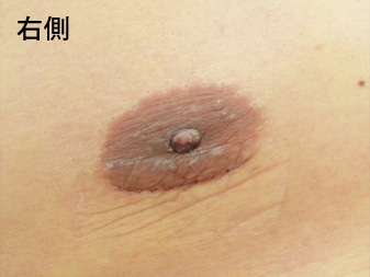 女性化乳房修正術症例№15、1週間後乳輪乳頭の状態右側