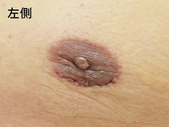 女性化乳房修正術症例№15、1週間後乳輪乳頭の状態左側