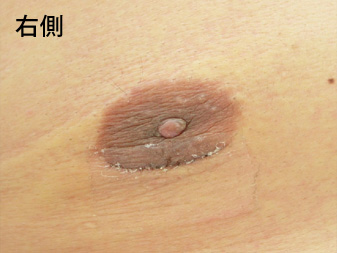 女性化乳房修正術症例№15、2週間後乳輪乳頭の状態右側