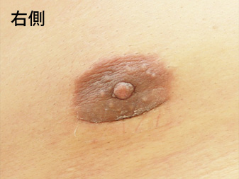 女性化乳房修正術症例№15、1ヶ月後乳輪乳頭の状態右側