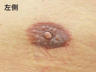 女性化乳房修正術症例№15、1ヶ月後乳輪乳頭の状態左側