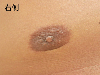 女性化乳房修正術症例№15、2ヶ月後乳輪乳頭の状態右側