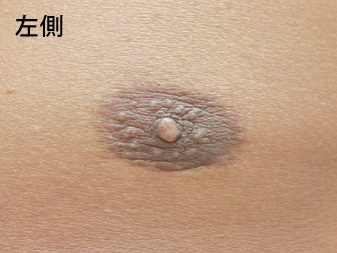 女性化乳房修正術症例№15、2ヶ月後乳輪乳頭の状態左側