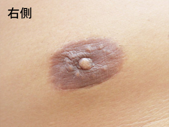 女性化乳房修正術症例№15、3ヶ月後乳輪乳頭の状態右側