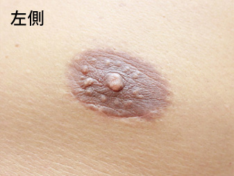 女性化乳房修正術症例№15、3ヶ月後乳輪乳頭の状態左側