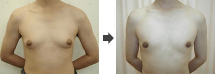 女性化乳房修正術症例№02before-after正面