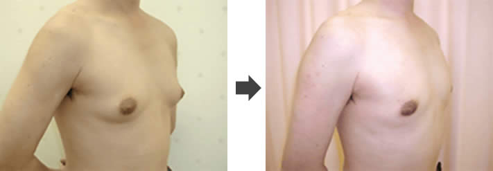 女性化乳房修正術症例№02before-after右斜め