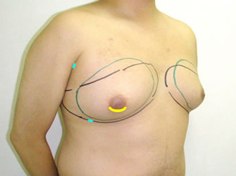女性化乳房修正術症例№04手術デザイン右斜め