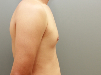 女性化乳房修正術症例№08術前右