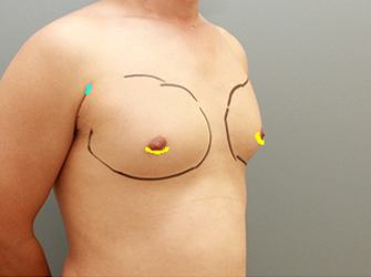 女性化乳房修正術症例№08手術デザイン右斜め